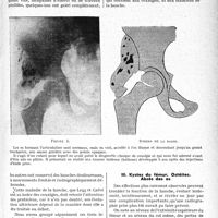 0564 - Page 563 - Partie scientifique. Travaux originaux. La pratique orthopédique de l’enfant et de l’adulte, Dr Raphaël Massart. Les affections non tuberculeuses de la hanche chez l’enfant. Coxa vara. Subluxations. Ostéochondrites / Kystes du fémur. Ostéites, Abcès des os