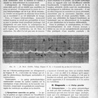 1408 - Page 1367 - Partie scientifique. Travaux originaux. Le bruit de galop, par Léon Giroux. Pathogénie du galop / Symptômes associés au galop / Diagnostic
