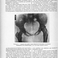 0457 - Page 426 - Partie scientifique. Travaux originaux. La pratique orthopédique de l'enfant et de l’adulte. Quelques idées nouvelles sur le traitement chirurgical des tuberculoses fermées, (Formes osseuses, articulaires, synoviales), par le Docteur Raphaël Massart. Nature des opérations à préconiser / Opérations qui réalisent l’immobilisation des segments osseux