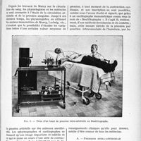 1540 - Page 1317 - Partie scientifique. Travaux originaux. Pression intra-artérielle et pression moyenne, par le Docteur René Giroux. Pression intra-artérielle