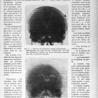 1604 - Page 1377 - Partie scientifique. Travaux originaux. Clinique chirurgicale. Encéphalographie par voie lombaire, par Georges Boudin