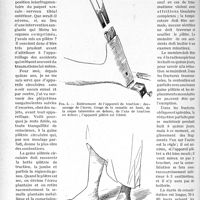 1957 - Page 1666 - Partie scientifique. Travaux originaux. Traitement orthopédique des fractures diaphysaires fermées de jambe, par le Docteur F. Masmonteil. Réduction. Contention / Consolidation