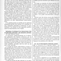 1975 - Page 1684 - Partie scientifique. L'actualité scientifique. Les Congrès. VIIIe congrès national de la tuberculose, (Marseille, 15-18 avril 1935), (Suite et fin). Question clinique. Sur la phrénicectomie et la pleurotomie. — M. Dumarest / Indications et technique de la thoracectomie dans la tuberculose pulmonaire, sans indications pleurales. — M. Léon Bérard / Un cas de thoracoplastie d’indication pleurale. — MM. A. Courcoux et A. Maurer