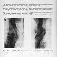 2268 - Page 1931 - Partie scientifique. Travaux originaux. Quelques réflexions sur le moment où il faut opérer les tuberculoses osseuses, C. Roederer et Ph. Graffin