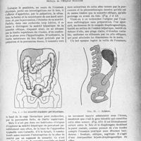 0778 - Page 779 - Partie scientifique. Travaux originaux. La sonorité angulaire pré-hépatique, signe de périviscérite du carrefour supérieur, par M. F. Trémolières