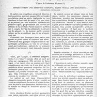 0079 - Page 76 - Partie scientifique. Le traitement des fractures du col du fémur chez les personnes âgées, par M. Raphaël Massart. La clinique urologique au goût du jour. Les masques de l’hypertrophie prostatique, d’après le Professeur Marion / Rétrécissement avec rétention complète ; polype vésical avec hématuries ; infections diverses [G. Fischer]