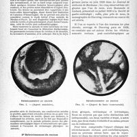 1797 - Page 1752 - Partie scientifique. Travaux originaux. Les complications ano-rectales de la curiethérapie et de la radiothérapie utérines, par MM. Pierre Oury, et Étienne Péraly. 2° Rectite et ulcérations rectales / 3° Rétrécissement du rectum