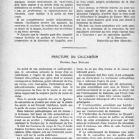 1437 - Page 1414 - Partie scientifique. Travaux originaux. Sur la technique de la neurolyse du nerf maxillaire inférieur au trou ovale / Fracture du calcanéum, Docteur Jean Poulain
