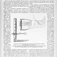 0681 - Page 678 - Travaux originaux. Appareillage pour fractures des doigts et des orteils, par le Docteur Lucien Dermer