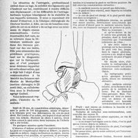 2009 - Page 1996 - Travaux originaux. Luxation complète de l'astragale, par le Docteur Aussilloux