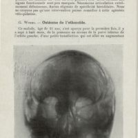 0732 - Page 730 - Sociétés savantes. Société de laryngologie des hôpitaux de Paris. Séance du 9 décembre 1925. André Bloch et J. Lemoine. - Malformation du voile et de la région amygdalienne gauche / G. Worms. - Ostéome de l'ethmoïde