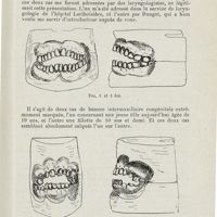 0846 - Page 845 - Sociétés savantes. Société de laryngologie des hôpitaux de Paris. Séance du 10 février 1926. M. Chenet. - Présenté par le Dr Rouget. - Deux cas de malformation du maxillaire supérieur