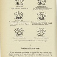 0930 - Page 918 - Mémoires. Indications thérapeutiques dans la tuberculose laryngée. Par le Dr Henri Caboche... Rapport au Congrès français d'oto-rhino-laryngologie. Octobre 1927. Deuxième partie. I. La cure de silence. Les instillations laryngo-trachéales et la trachéo-fistulisation. Le pneumothorax artificiel / II. Traitement chirurgical
