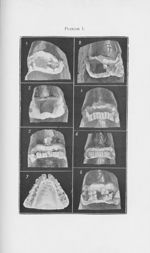 [Anomalies dentaires acquises ] - L'Odontologie