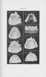 [Anomalies dentaires acquises ] - L'Odontologie