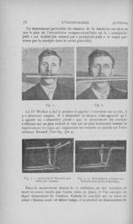 Fig. 1 / Fig. 2 / Fig. 3. — Articuiateur Bonwill modifié par L’auteur / Fig. 4. — Articulateur origi [...]