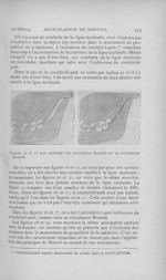 Figures 16 et 17 nous montrant une articulation Bonwill sur un articulateur Bonwill - L'Odontologie