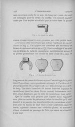 Fig. 3. Le coude de métal / Fig. 4. — L’appeau de caoutchouc - L'Odontologie