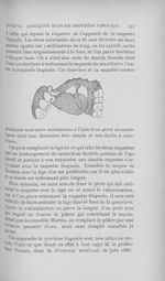 L'appareil de la raquette linguale - L'Odontologie