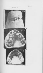 [Conséquences d’une hémihypertrophie faciale sur le système dentaire] - L'Odontologie