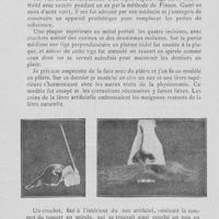 0423 - Page 416 - Revue de l’étranger. Modification de la couronne Richmond par Hermann-Barduch (Quarterly Circular) / Un cas de restauration faciale par Alex. Mertens (Dental Cosmos, mars 1906.)