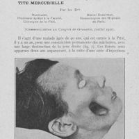 0114 - Page 111 - Faits cliniques un cas de perforation jugale secondaire à un noma ayant compliqué une stomatite mercurielle par les Drs Mauclaire et Marcel Darchissac. P| Fig. 1