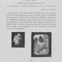 0158 - Page 153 - Travaux originaux. Dentome corono-radiculaire occasionnant du névralgisme facial par R. Morin