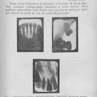 0804 - Page 661 - Travaux originaux. Présentation de clichés du service radiographique de l'école dentaire de Parispar Mlle Marthe Caen
