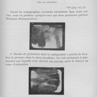 0878 - Page 735 - Travaux originaux. Présentation de clichés du service radiographique de l'école dentaire de Parispar Mlle Marthe Caen