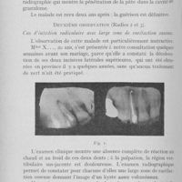0427 - Page 418 - Travaux originaux. L'acide trichloracétique en thérapeutique bucco-dentaire par le Dr Marcel Darcissac / Travaux originaux. L'acide trichloracétique en thérapeutique bucco-dentaire par le Dr Marcel Darcissac