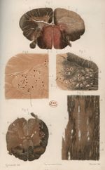 Planche I - Etude anatomique et clinique de la sclérose en plaques