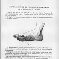 0115 - Page 113 - Société des sciences médicales de Madagascar. Séance du 20 octobre 1936. Au sujet de la présence de foyers de bilharziose vésicale dans la région d'Ambanja, par M. Guillier. / Naevo-carcinome du pied chez un malgache, par G. Moustardier et J. Robert