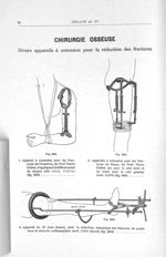 Chirurgie osseuse. Divers appareils à extension pour la réduction des fractures. 1. Appareil à exten [...]