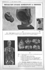 Préparations diverses représentants la grossesse : VII. - demi-bassin avec utérus au 9ème mois de la [...]