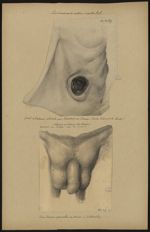 Cas d'anus contre-nature accidentel / Fistule de l'estomac observée par Corvisart et Leroux (tiré du [...]