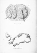 Placenta double; cordon ombilical - Nouvelles démonstrations d'accouchements