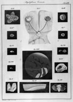 Staphyloma corneae - Klinische Darstellungen der Krankheiten des menschlichen Auges nach eigenen Beo [...]