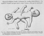 Monstre ischiopage dont deux des membres inférieurs sont soudés en un seul - Traité d'anatomie patho [...]