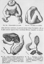 Dérencéphale - Traité d'anatomie pathologique