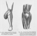 Lipomes - Traité d'anatomie pathologique