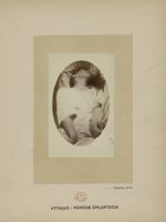 Planche XVII. Attaque : période épileptoïde - Iconographie photographique de la Salpêtrière : servic [...]