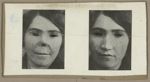 [Portraits d'une femme, de face, avant et après pose de prothèse nasale.]