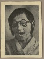 [Portrait de femme après pose de prothèse oculo faciale / Prothèse oculo-faciale.]