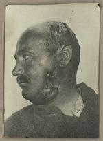 [Portrait de profil préopératoire montrant une plaie en cratère au niveau de l'angle du maxillaire i [...]