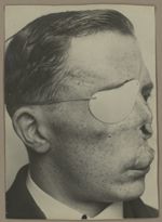 [Portrait de profil d'un homme présentant une perte de substance au niveau du nez et un cache-œil à  [...]