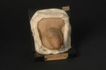 Chancre syphilitique du gland, forme papuleuse ; syphilides papuleuses du scrotum et de la région pu [...]