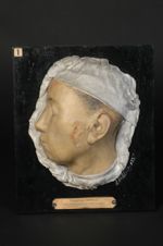 Lupus érythémato-acnéique de la joue gauche et de la région mastoïdienne. Femme âgée de 38 ans, cout [...]