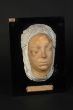 Gommes syphilitiques de la face. La guérison a eu lieu par résolution. Femme âgée de 33 ans, couturi [...]