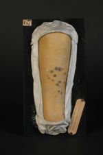 Syphilide pustulo-crustacée (Inv. 1889) de l'avant-bras. Psoriasis syphilitique