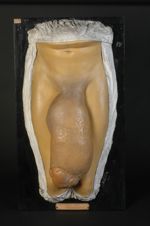 Éléphantiasis de la verge et du scrotum. Homme âgé de 29 ans, menuisier (V. le n° 89, même malade ap [...]